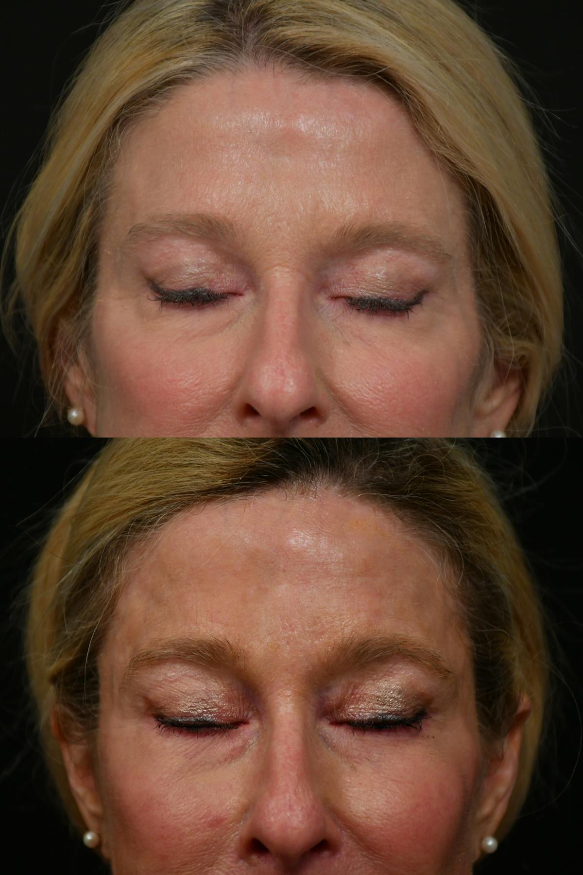 Lip Lift Before & After Gallery - Patient 170755 - Image 9