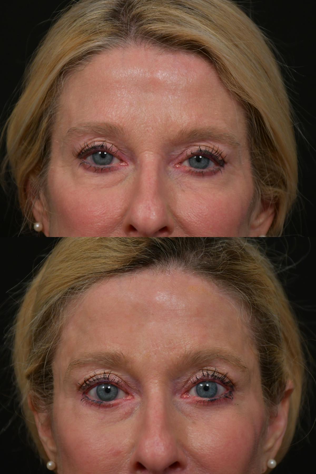 Lip Lift Before & After Gallery - Patient 170755 - Image 7