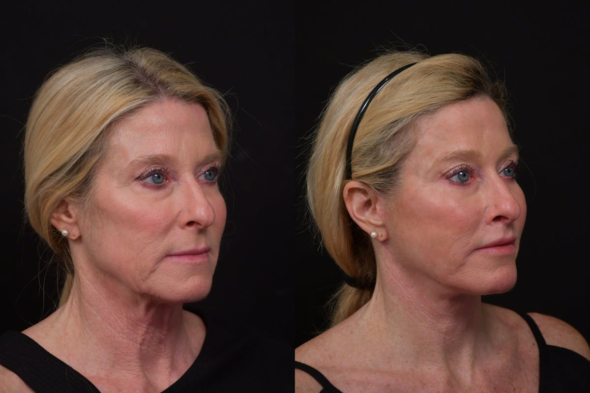 Lip Lift Before & After Gallery - Patient 170755 - Image 2