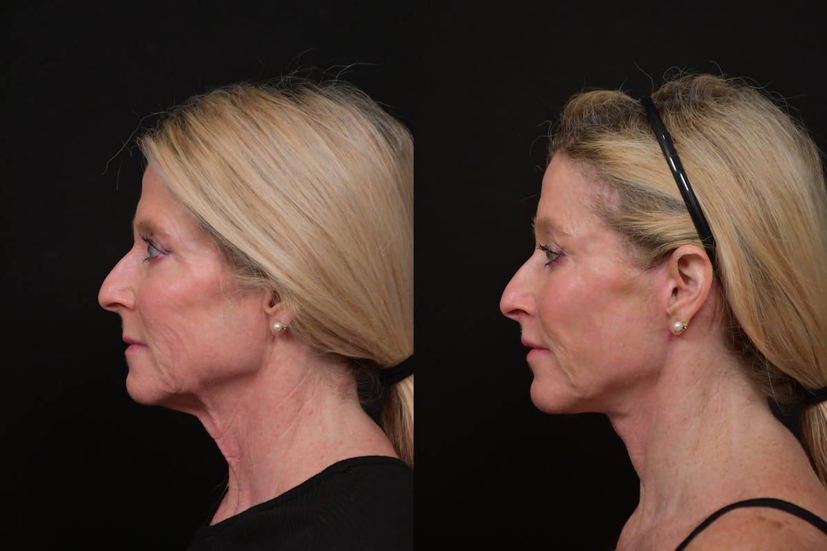 Lip Lift Before & After Gallery - Patient 170755 - Image 5