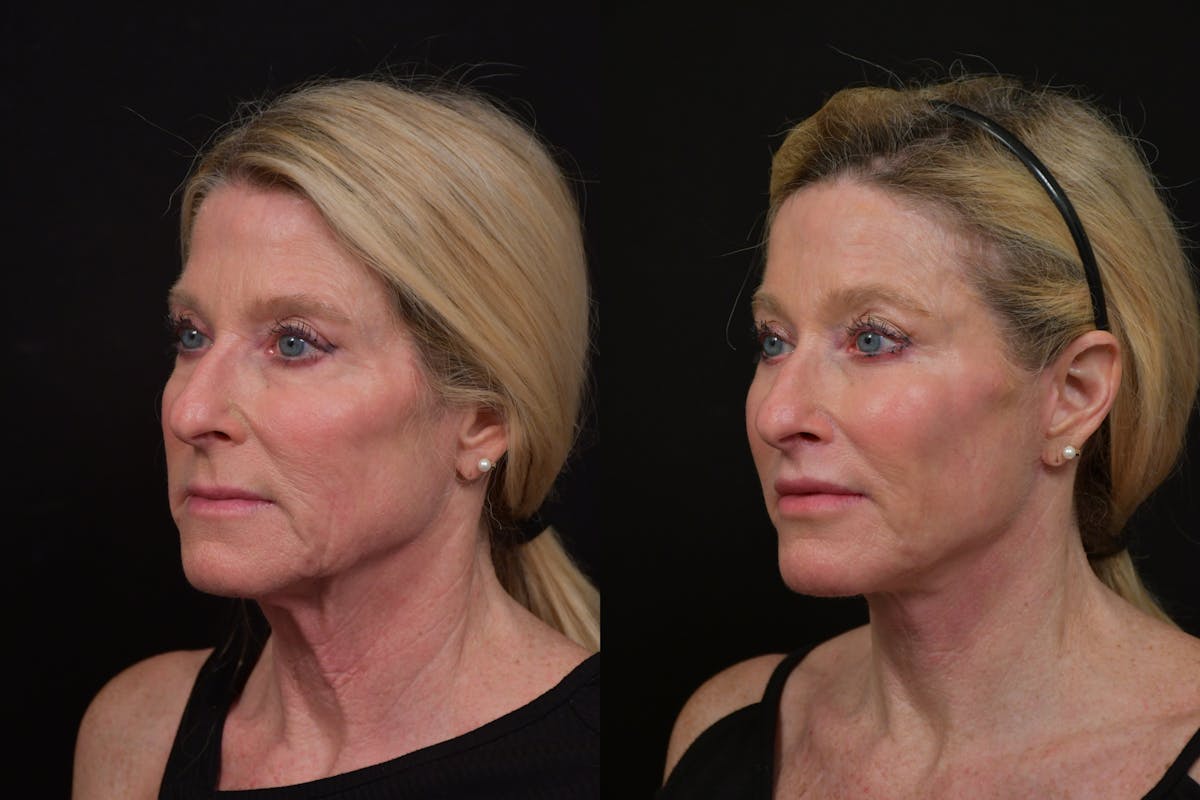 Lip Lift Before & After Gallery - Patient 170755 - Image 4