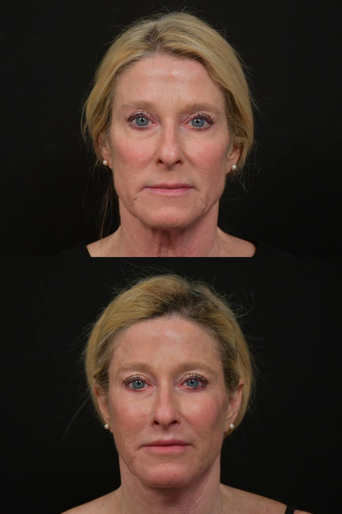 Lip Lift Before & After Gallery - Patient 170755 - Image 6