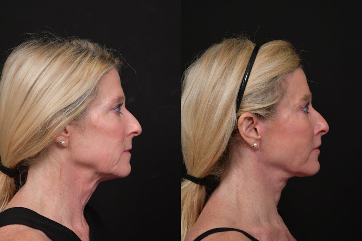 Lip Lift Before & After Gallery - Patient 170755 - Image 3