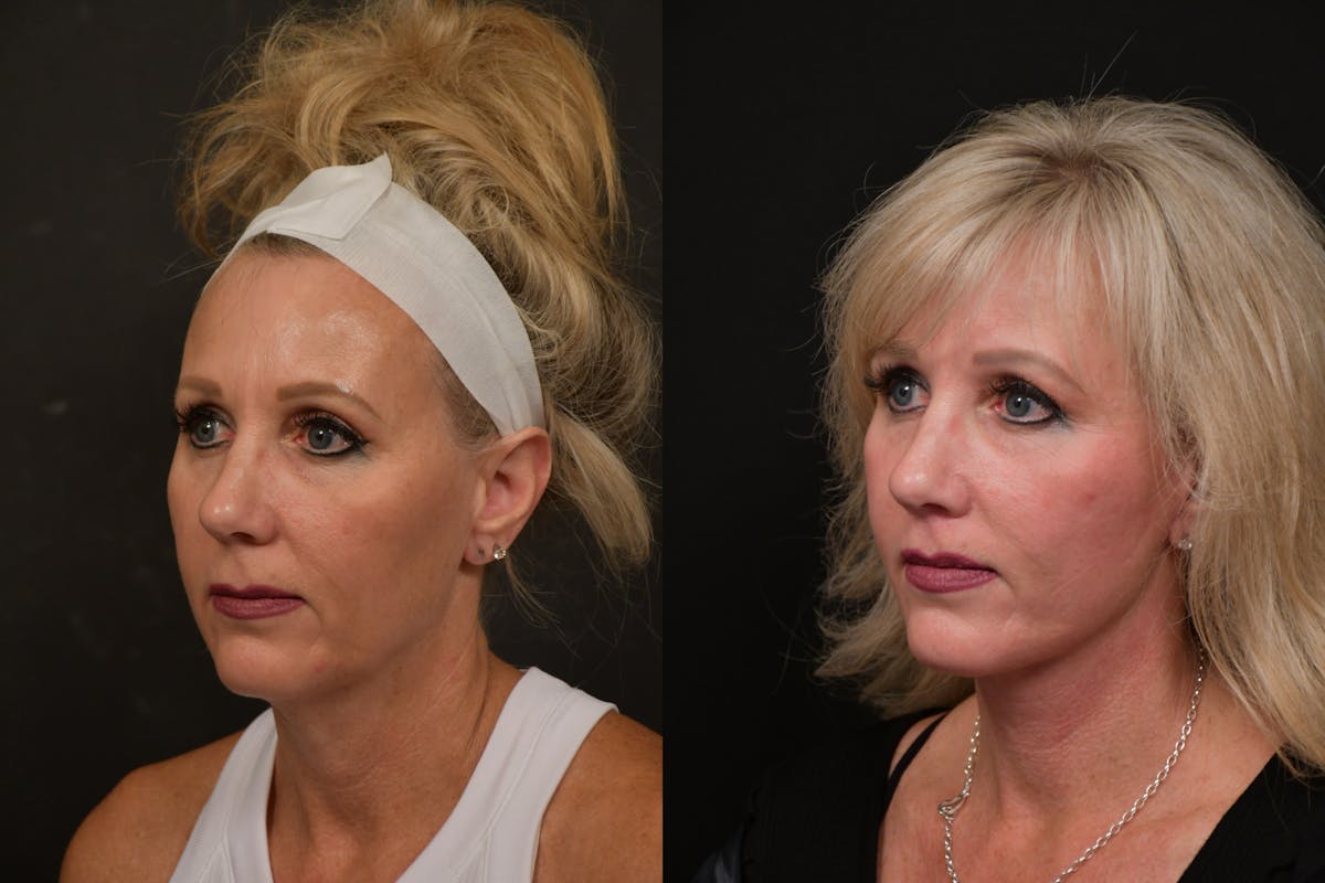 Changes Deep Plane Face Lift  Before & After Gallery - Patient 402220 - Image 1