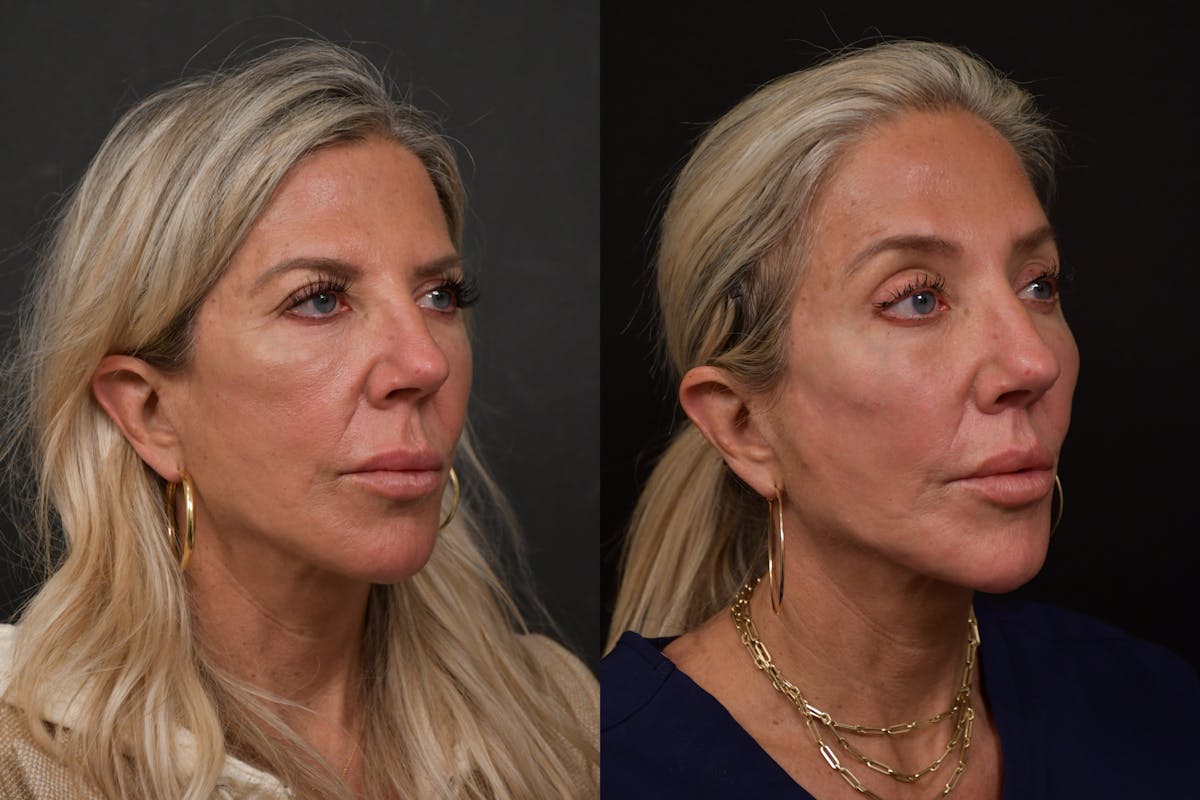 Brow Lift Before & After Gallery - Patient 420261 - Image 2