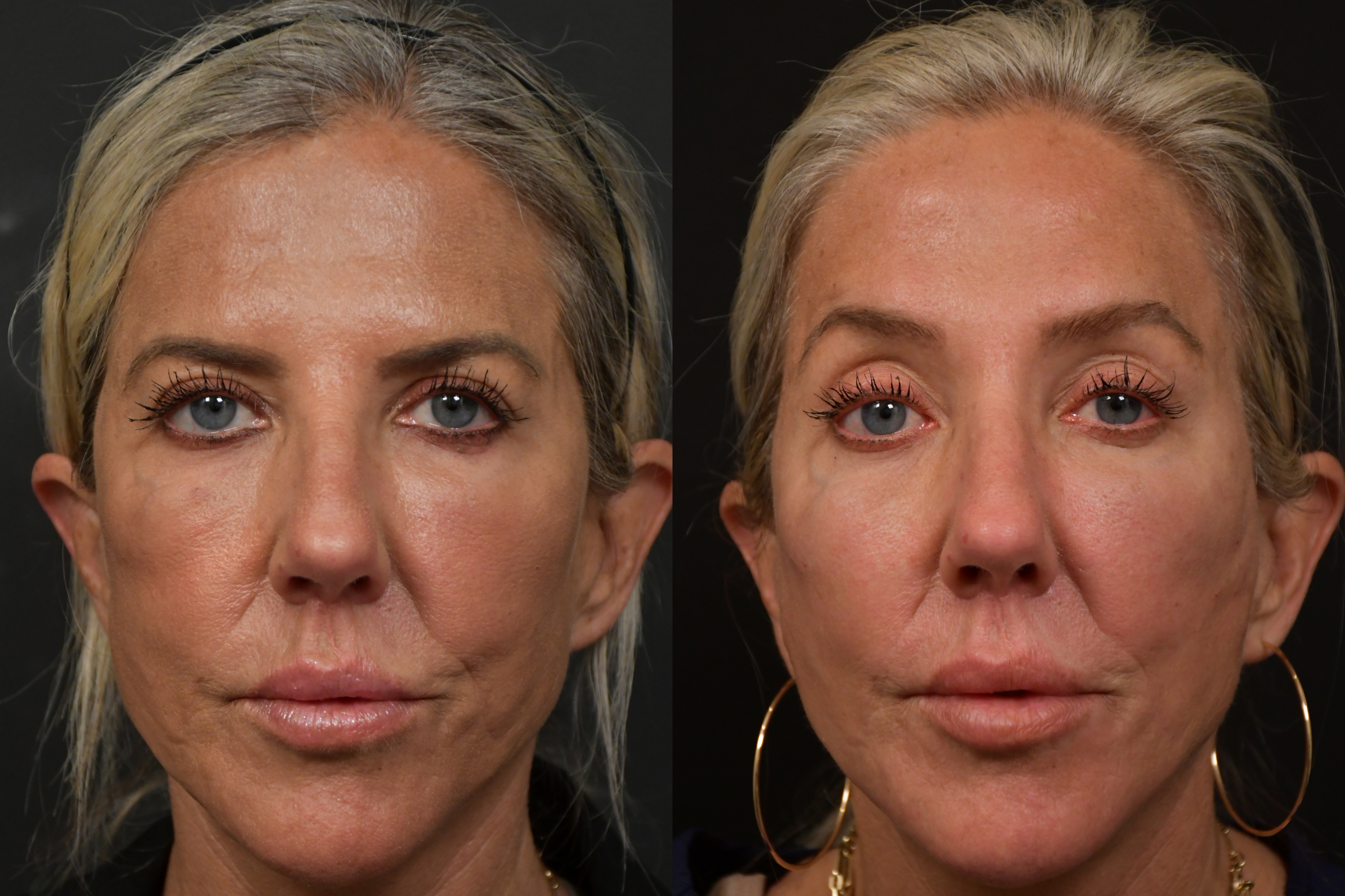 Patient 321914 | Lip Lift Before & After Photos | Changes Plastic