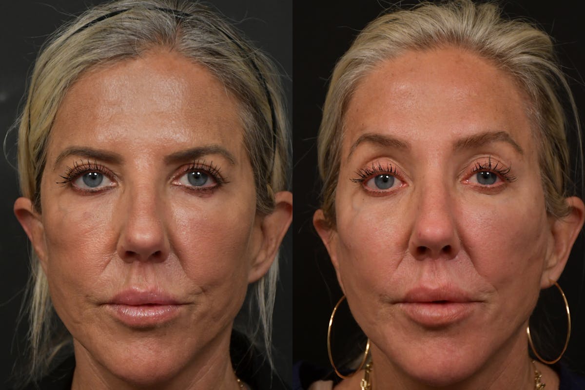 Brow Lift Before & After Gallery - Patient 420261 - Image 1