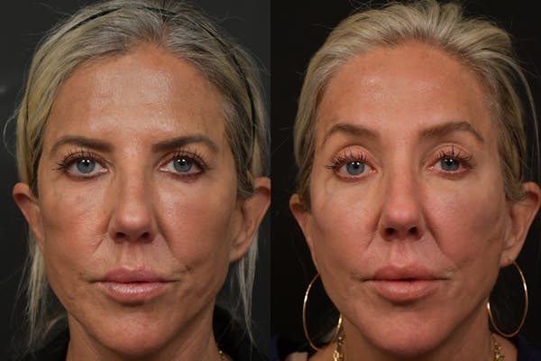 Brow Lift Before & After Gallery - Patient 420261 - Image 1