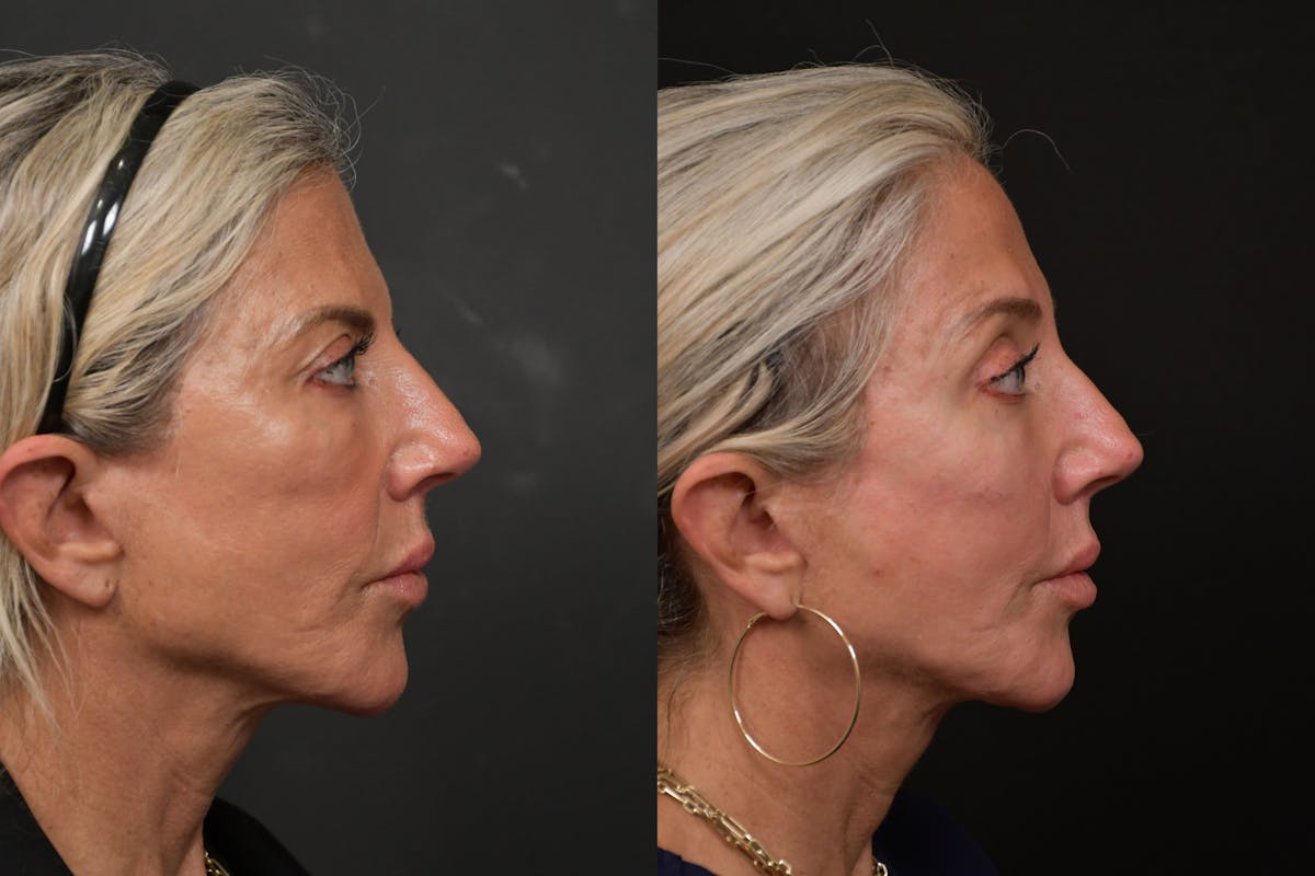 Brow Lift Before & After Gallery - Patient 420261 - Image 3