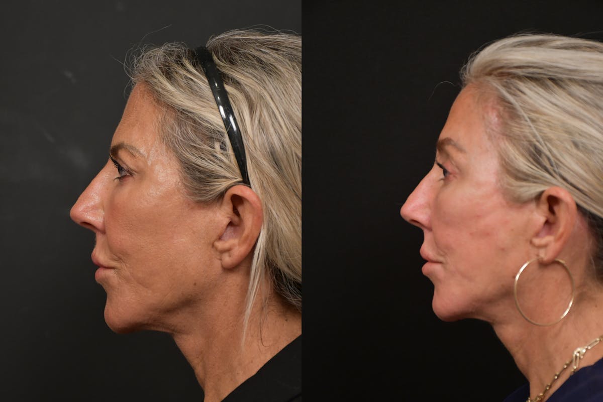 Brow Lift Before & After Gallery - Patient 420261 - Image 5