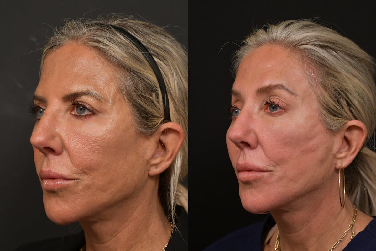 Brow Lift Before & After Gallery - Patient 420261 - Image 4