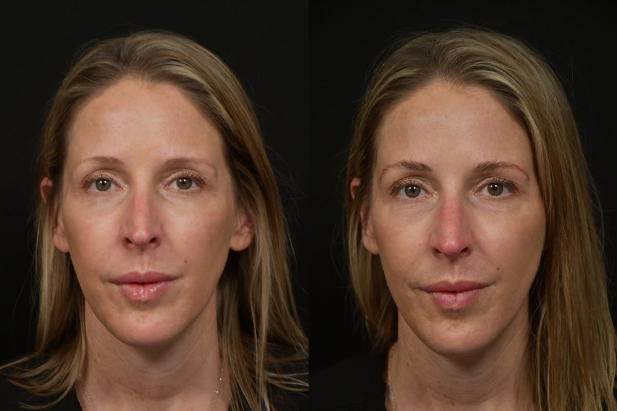 Brows and Lashes Before & After Gallery - Patient 259504 - Image 1