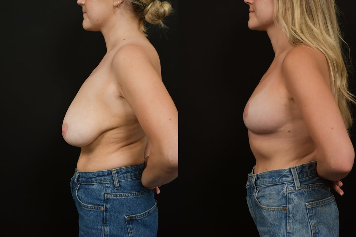 Breast Reduction Before & After Gallery - Patient 389812 - Image 5