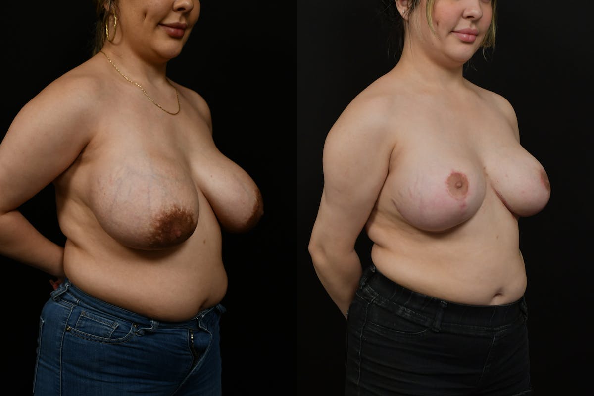Breast Reduction Before & After Gallery - Patient 156608 - Image 2
