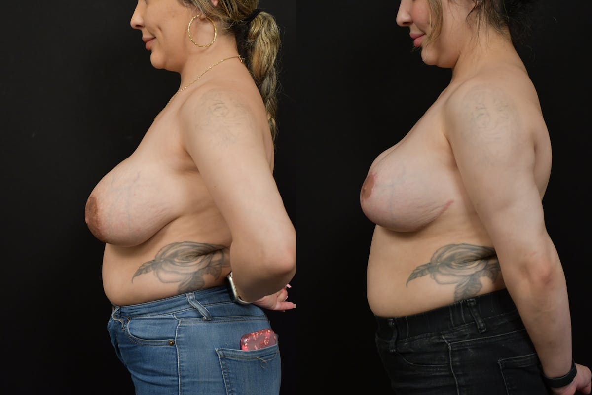 Breast Reduction Before & After Gallery - Patient 156608 - Image 5