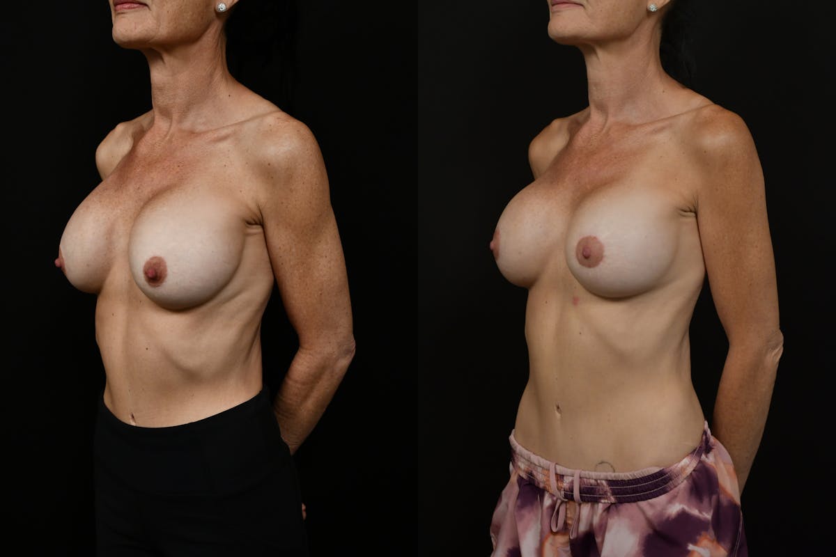 Breast Augmentation Before & After Gallery - Patient 745487 - Image 4