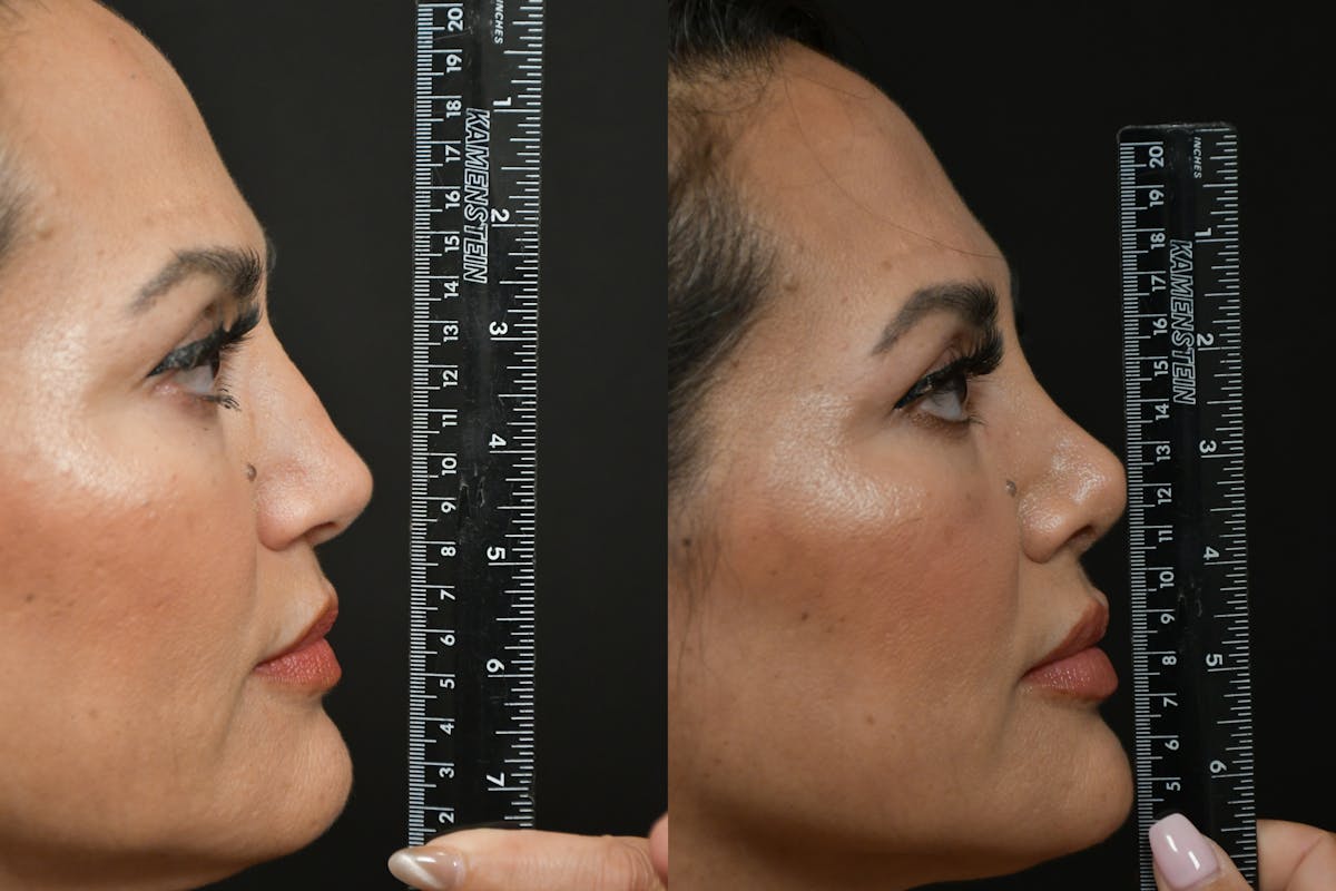 Rhinoplasty Before & After Gallery - Patient 270198 - Image 7