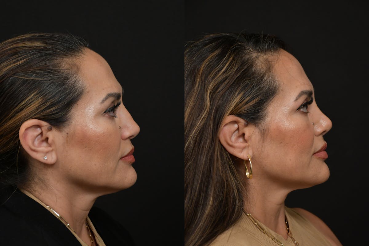 Rhinoplasty Before & After Gallery - Patient 270198 - Image 4
