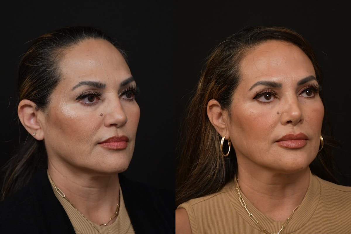 Rhinoplasty Before & After Gallery - Patient 270198 - Image 3