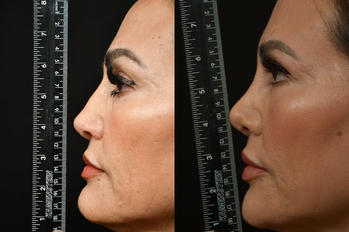 Rhinoplasty Before & After Gallery - Patient 270198 - Image 6