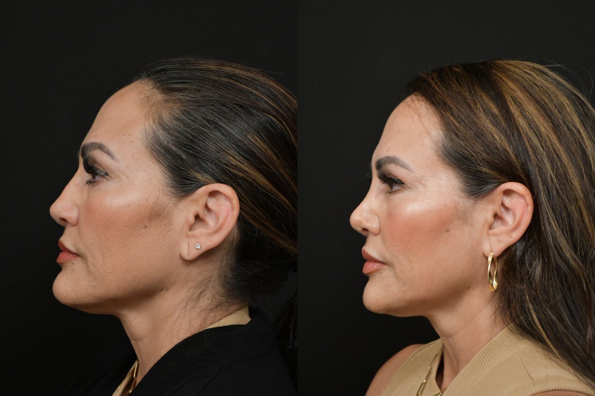 Rhinoplasty Before & After Gallery - Patient 270198 - Image 2