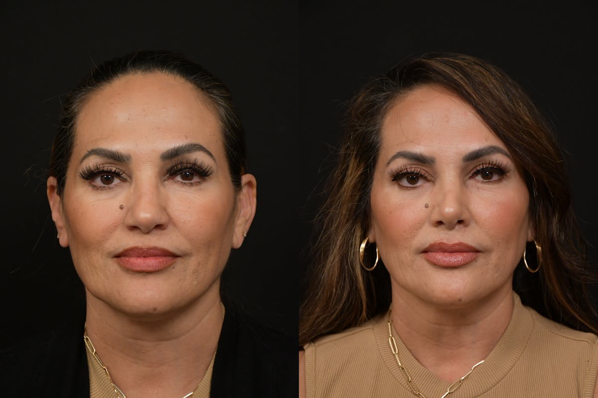 Rhinoplasty Before & After Gallery - Patient 270198 - Image 5