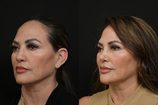 Rhinoplasty Before & After Gallery - Patient 270198 - Image 1