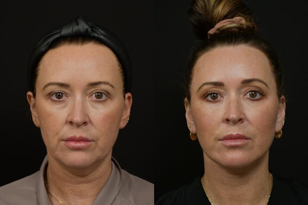 Eyelid Surgery Before & After Gallery - Patient 251258 - Image 1