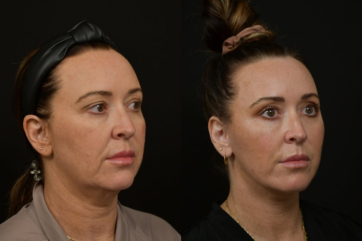 Neck Lift Before & After Gallery - Patient 876433 - Image 3
