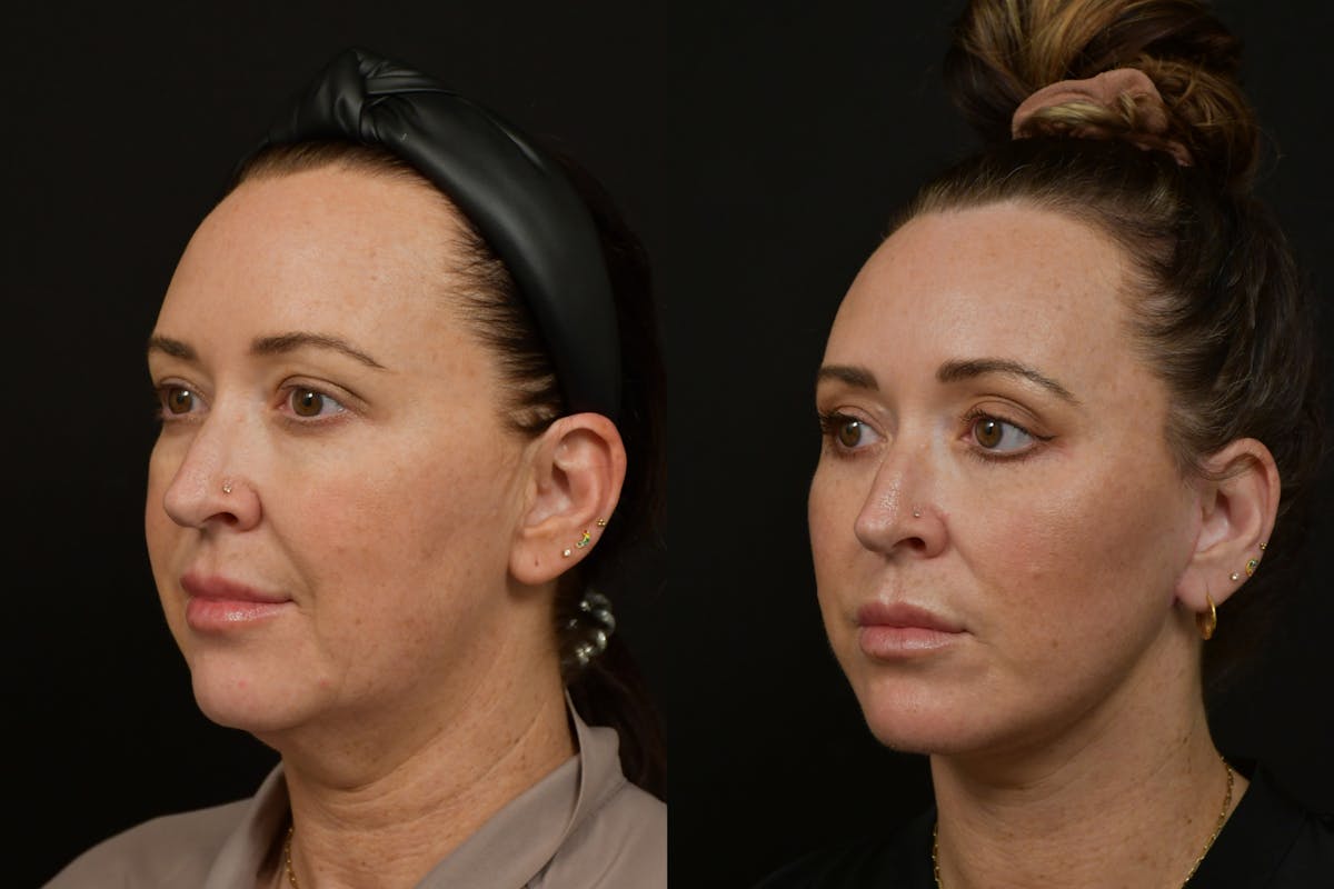 Neck Lift Before & After Gallery - Patient 876433 - Image 1