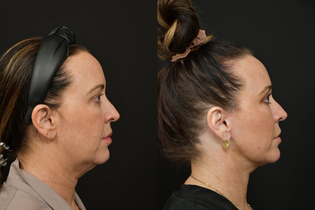 Neck Lift Before & After Gallery - Patient 876433 - Image 4