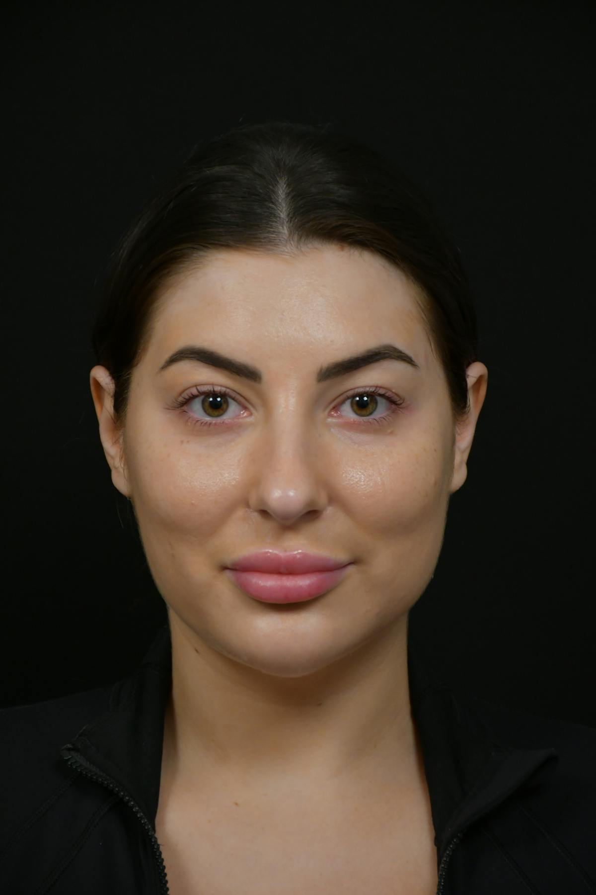 Jawline/Chin Before & After Gallery - Patient 787108 - Image 1