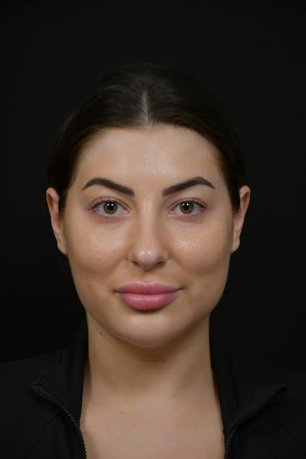 Injectables Before & After Gallery - Patient 933467 - Image 1