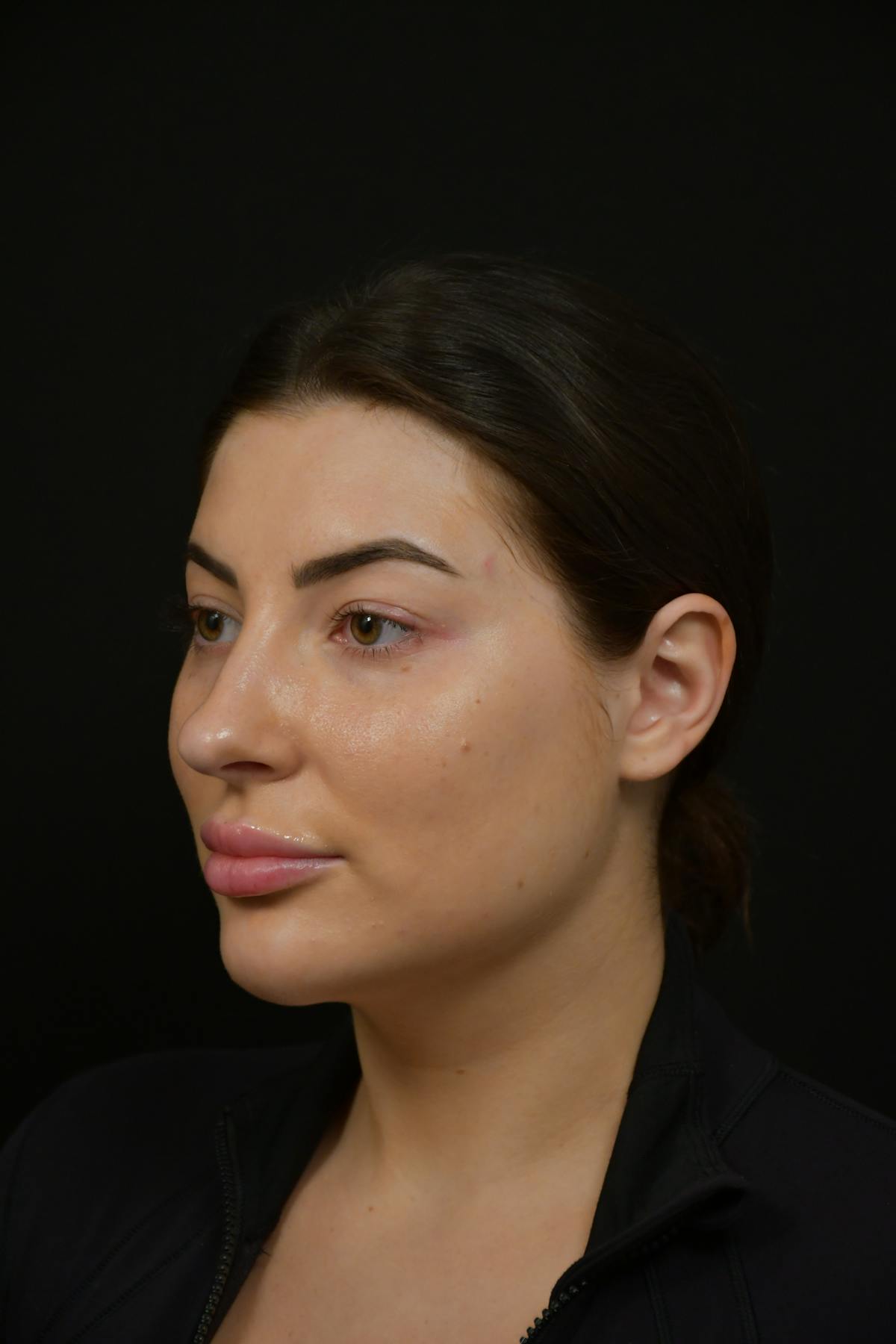 Jawline/Chin Before & After Gallery - Patient 787108 - Image 4