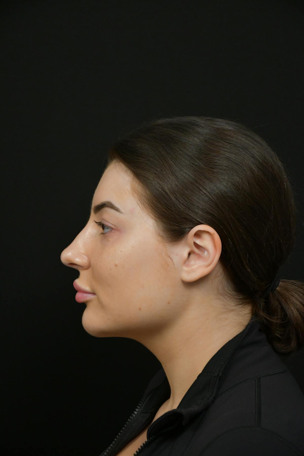 Jawline/Chin Before & After Gallery - Patient 787108 - Image 5