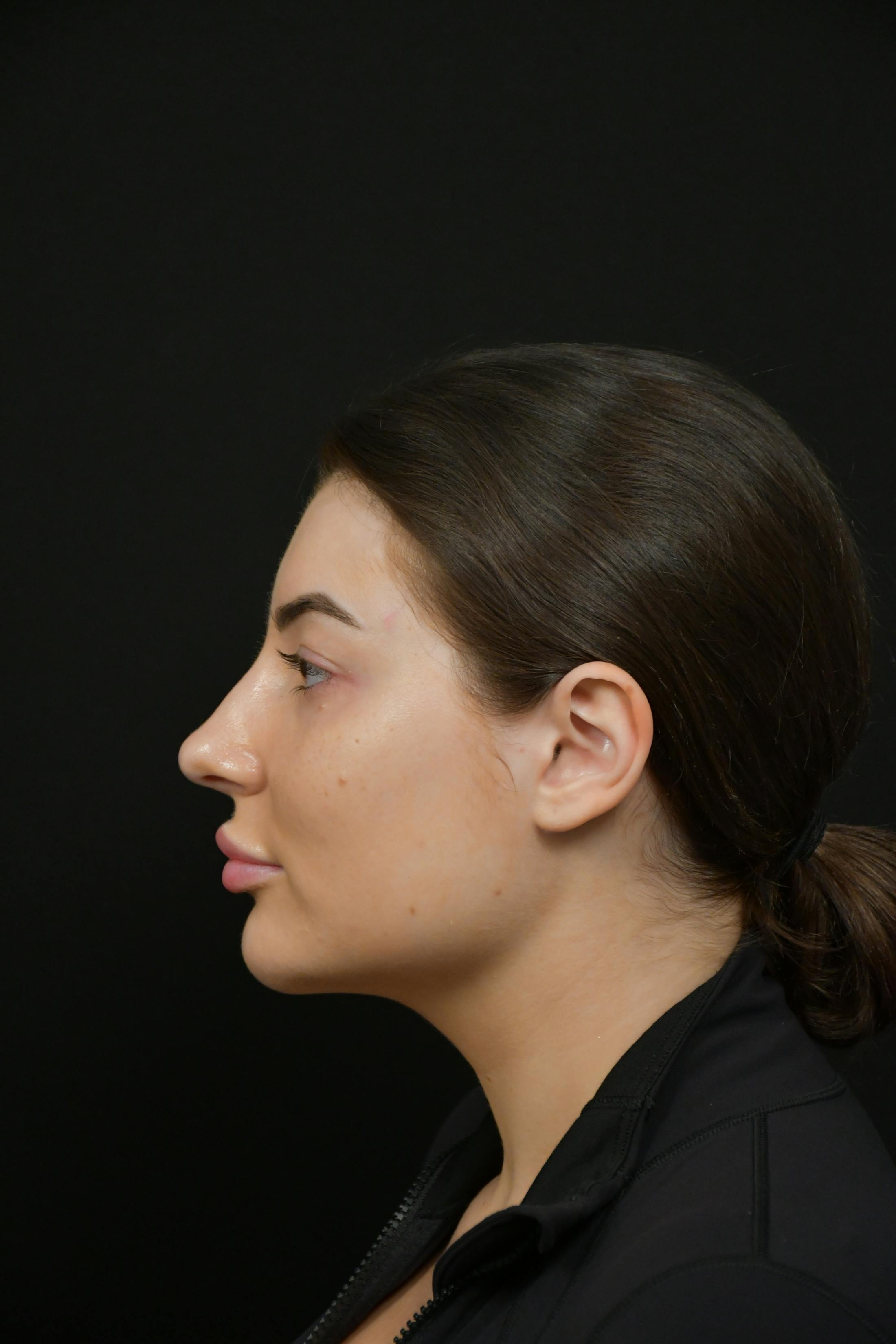 Jawline/Chin Before & After Gallery - Patient 787108 - Image 5