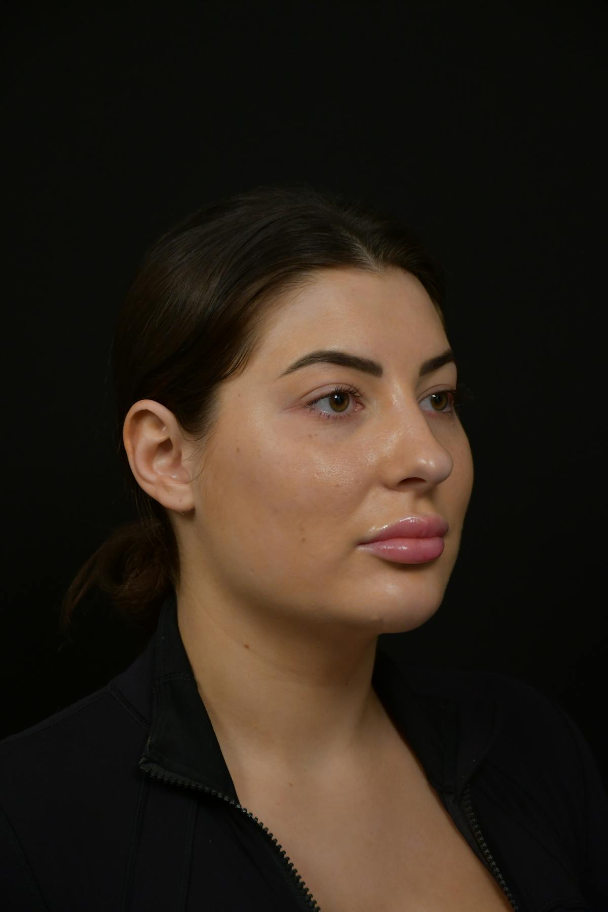 Jawline/Chin Before & After Gallery - Patient 787108 - Image 2
