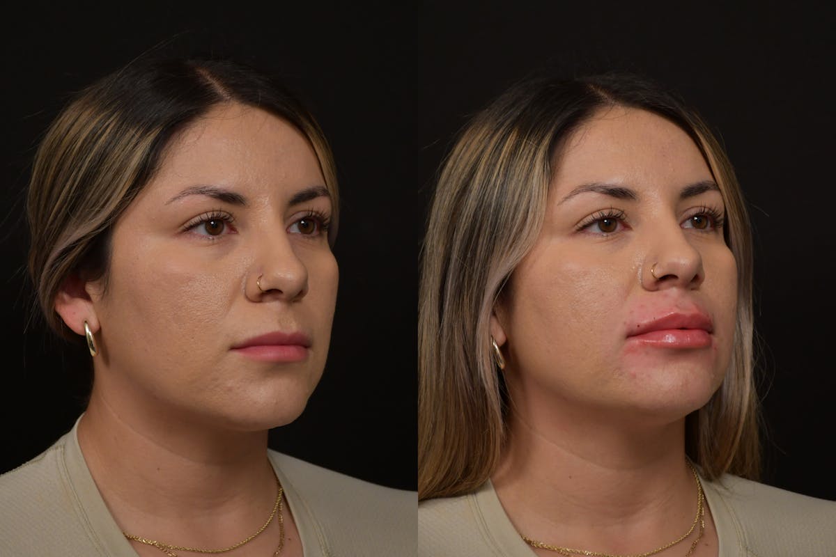 Lips Before & After Gallery - Patient 791590 - Image 2