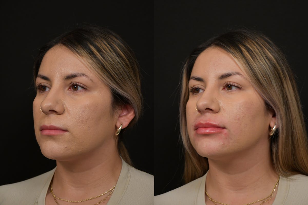 Lips Before & After Gallery - Patient 791590 - Image 3