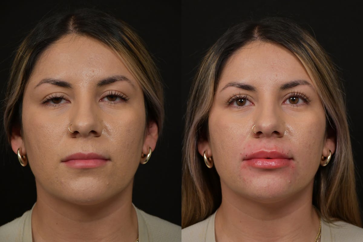 Lips Before & After Gallery - Patient 791590 - Image 1