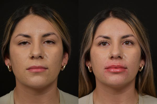 Injectables Before & After Gallery - Patient 942064 - Image 1