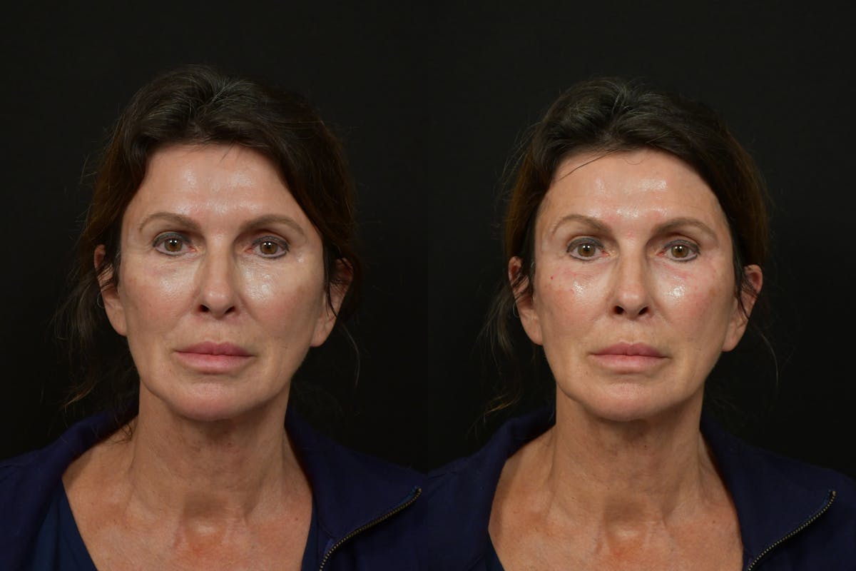 Under Eyes Before & After Gallery - Patient 366068 - Image 1