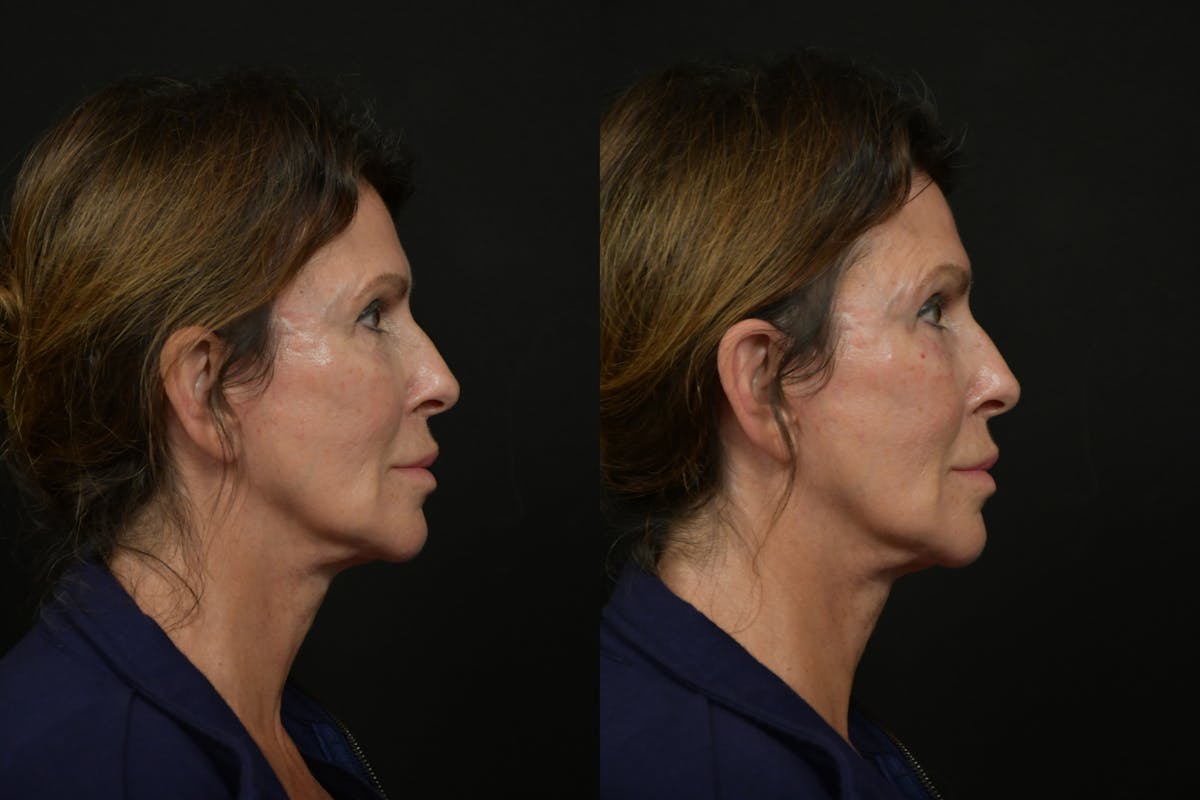 Under Eyes Before & After Gallery - Patient 366068 - Image 3