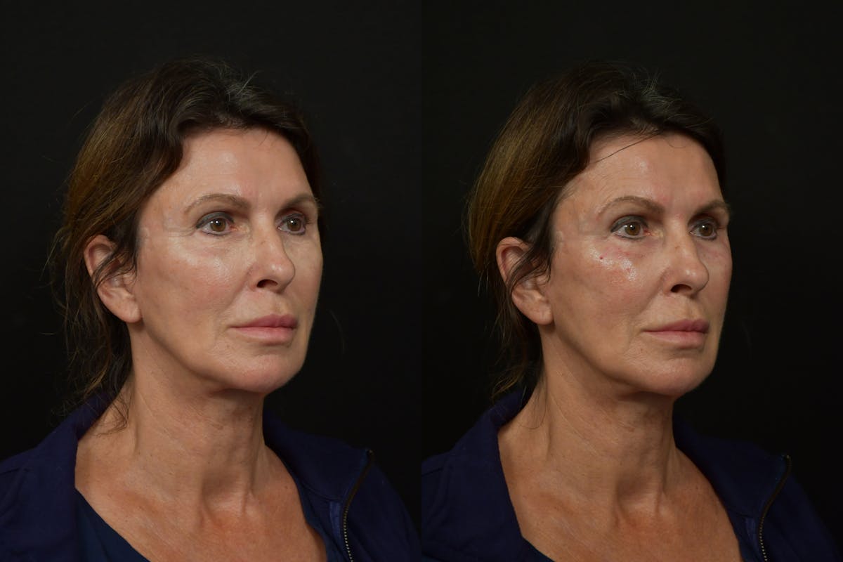Under Eyes Before & After Gallery - Patient 366068 - Image 2