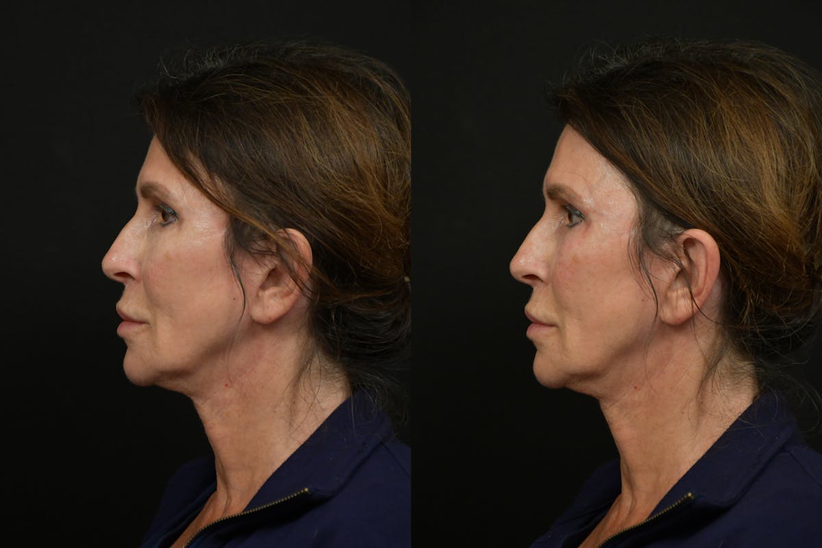 Under Eyes Before & After Gallery - Patient 366068 - Image 5