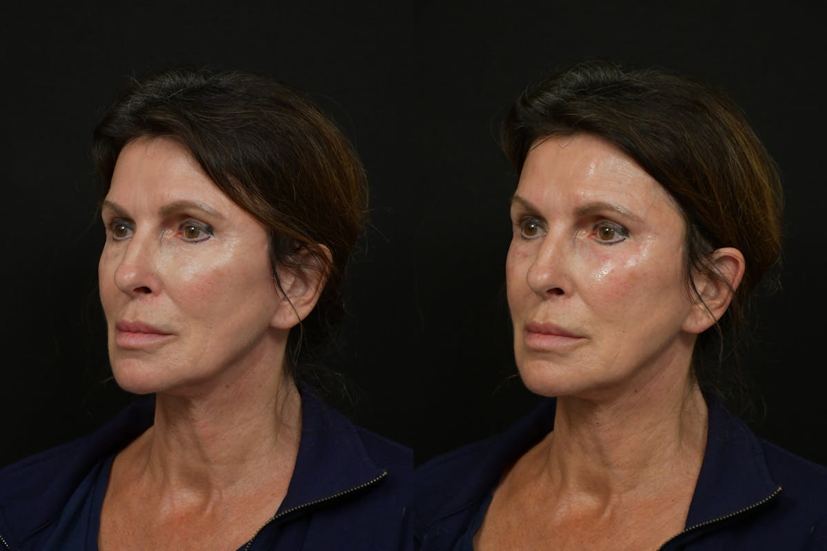 Under Eyes Before & After Gallery - Patient 366068 - Image 4