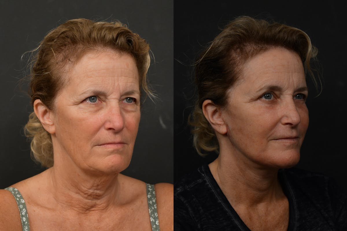 Changes Deep Plane Face Lift  Before & After Gallery - Patient 283471 - Image 3