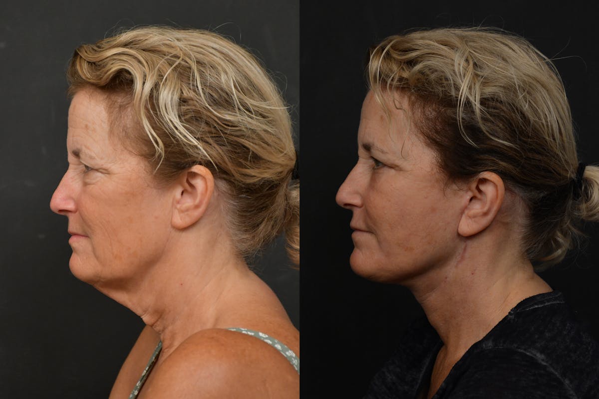 Changes Deep Plane Face Lift  Before & After Gallery - Patient 283471 - Image 2