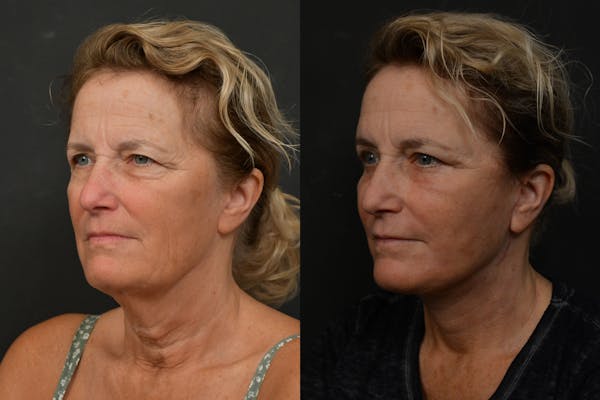Neck Lift Before & After Gallery - Patient 132062 - Image 1