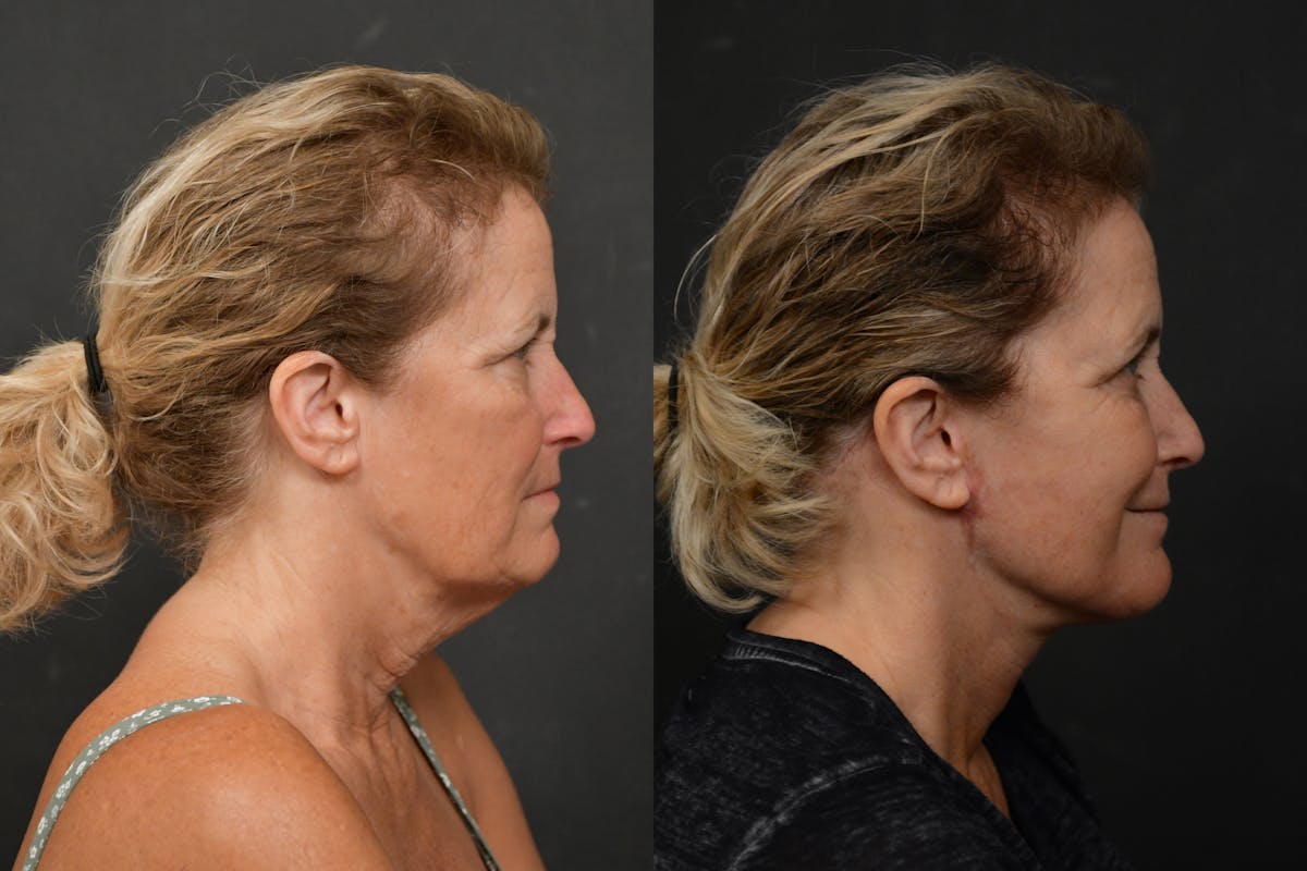 Changes Deep Plane Face Lift  Before & After Gallery - Patient 283471 - Image 4